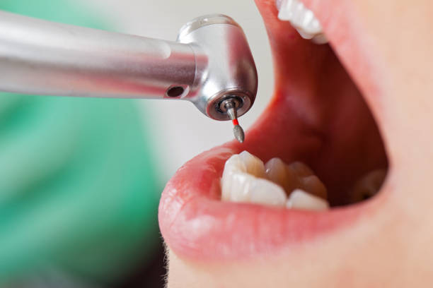 Best Emergency Dental Extractions in Winfield, IL